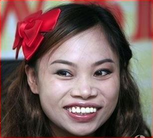 龅牙不但使外貌不美观,更会对全身造成伤害!