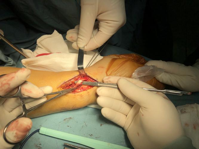 写美篇 分享一例粉碎的桡骨远端骨折手术,运用掌背侧联合入路进行复位