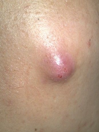 脸上的大疙瘩什么时候下去啊!不是粉刺,就是感觉里面