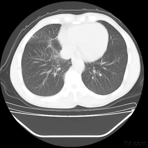肺癌ct片 ! - 医学影像学讨论版 - 爱爱医医学论坛