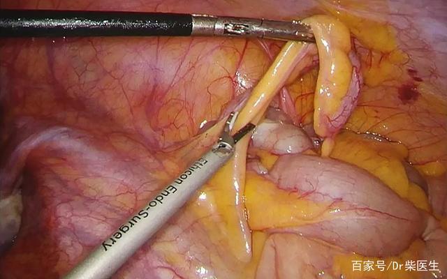 慢性阑尾炎切还是不切