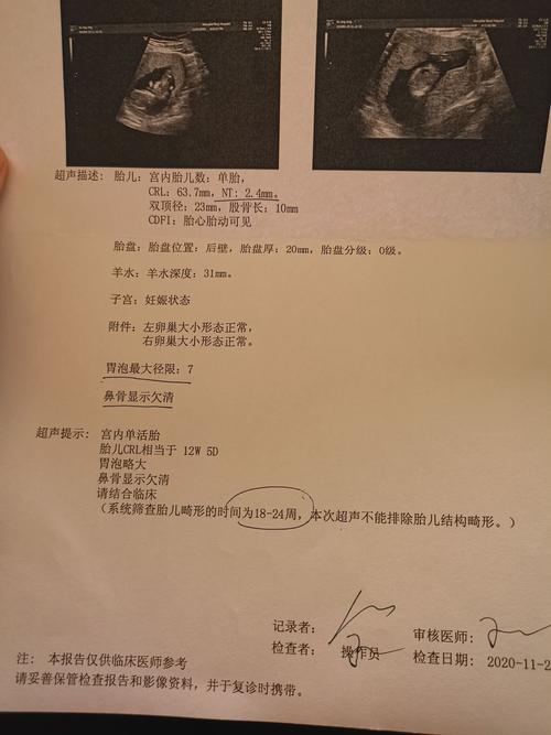 [试管婴儿]好难过,nt没过关,宝宝鼻骨显