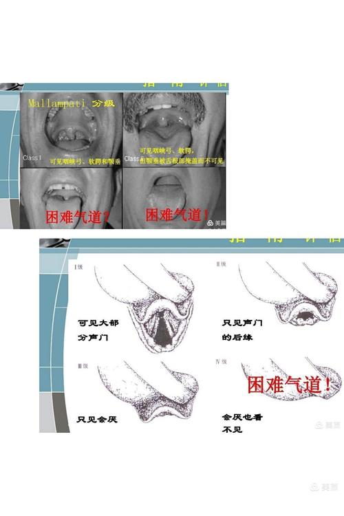 根据困难气道评估指南,mallampati iv级!