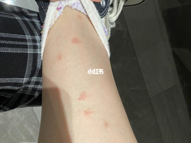 这是蚊子咬的还是螨虫咬的啊_螨虫_生活记录_接