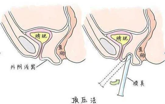 【硬核技术】男友为25岁"石女"寻医