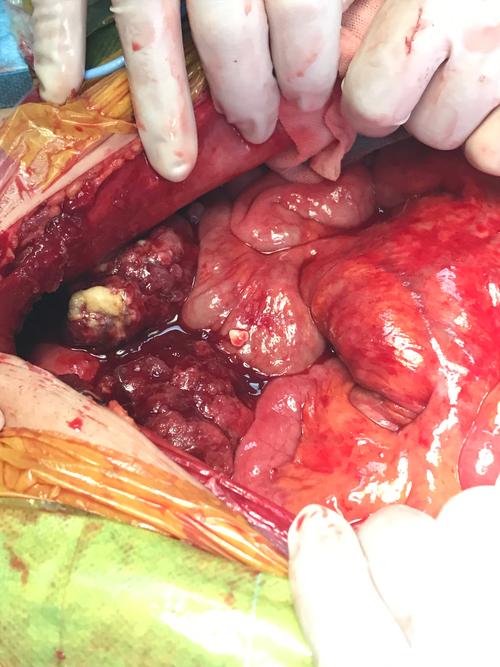 卵巢癌早期诊断较困难