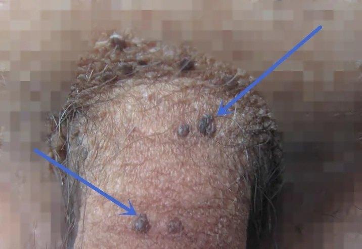 粗糙,通常 无特殊感觉,以后进一步增生成 疣状, 菜花状突起并向外周