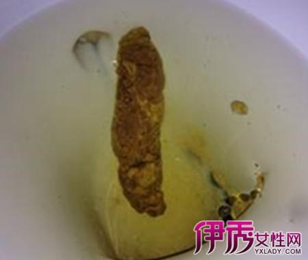 伊秀生活网 健康 / 正文 肛门大便便血突然出现了鲜红,或覆盖于粪便