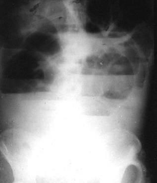 结 肠 梗 阻 c t 平 扫 ★结肠梗阻—ct平扫见结肠肠腔扩张及结肠