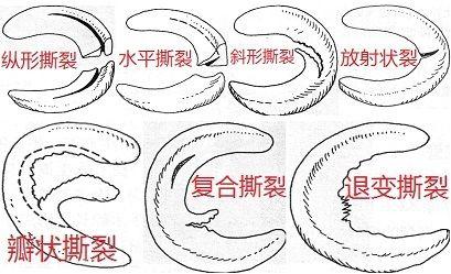 年轻人半月板撕裂多于运动损伤相关,关节镜下半月板切除术后