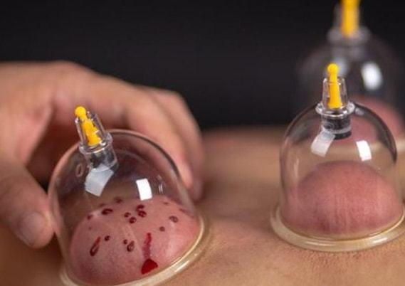 后背会留下颜色,很多人以为这是身体中排出的毒素,说明拔罐有一定的