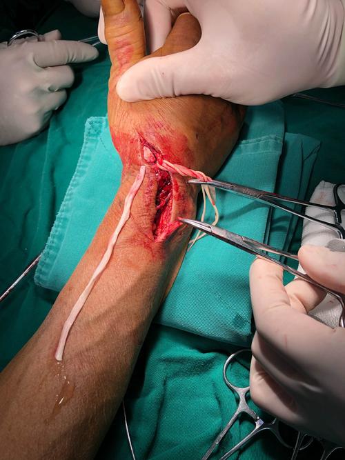 拇长伸肌腱自发性断裂