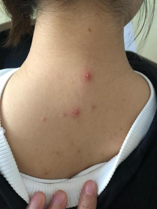 脖子后面有疙瘩 谁知道是怎么回事?是火气太大了吗?