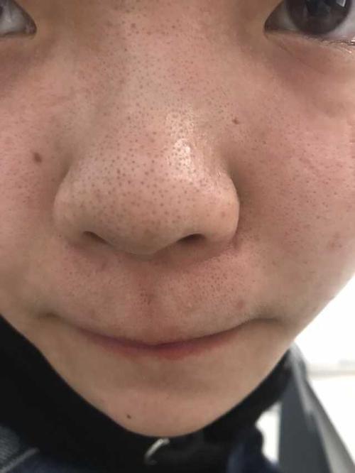 弄得鼻子像个草莓一样,不化妆一颗颗黑点点,化妆了浮粉又超级严重