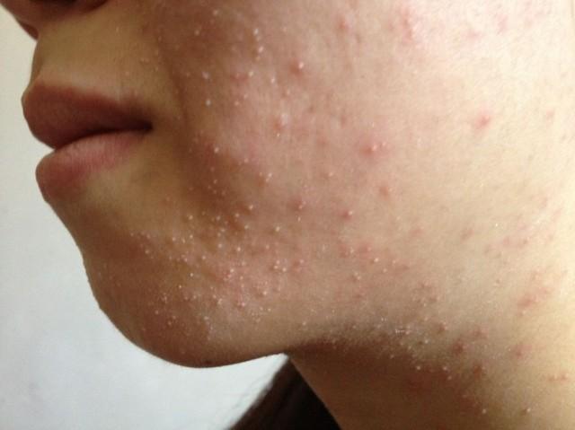 轻松教你去除脸上粉刺的方法