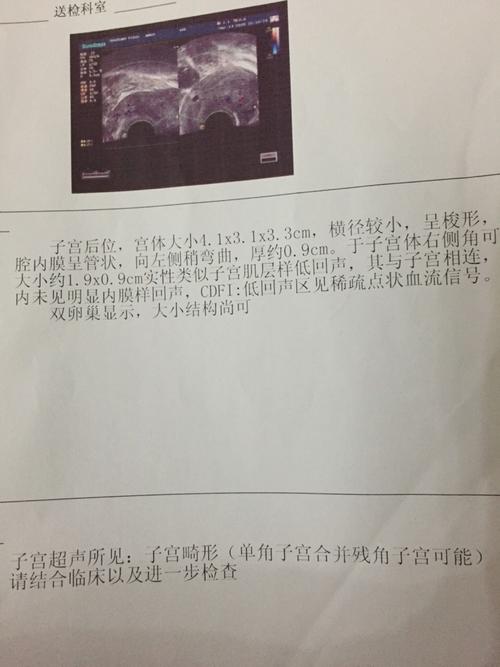 [试管婴儿]单角子宫合并残角子宫,试管