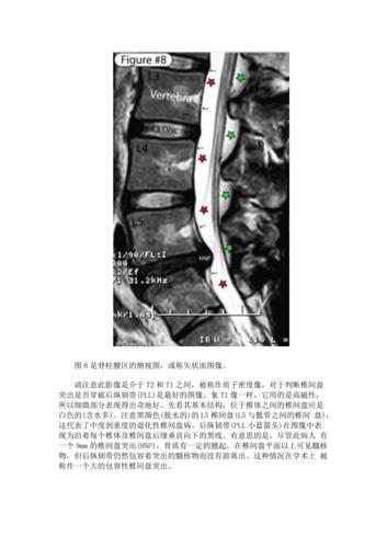 3分钟学会看腰椎mri片