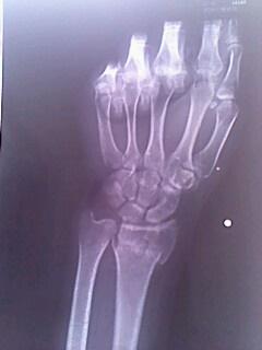 左手桡骨在4月9号的时候骨折和错位~之后到医院医生骨头对接,当时x光