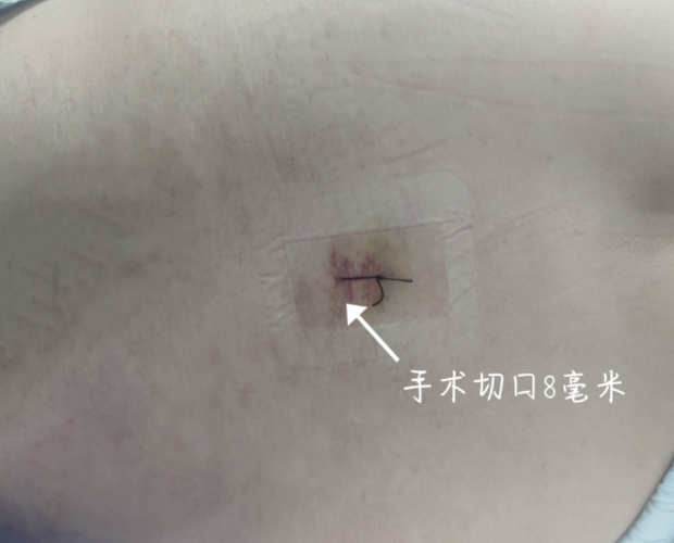 peid治疗巨大腰椎间盘突出症——脊柱微创手术
