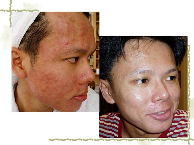 发水痘第四天了去医院看了医生开了阿昔洛韦片说吃药就可以今天起来