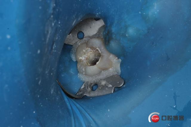 46去除颌面暂封物后,远中壁尚存,未侧穿