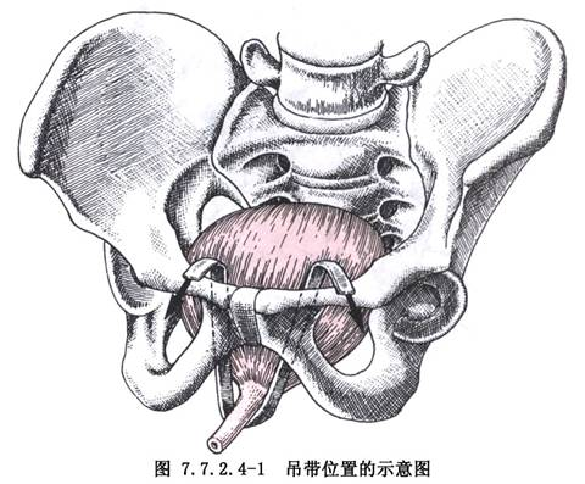 2) 经闭孔尿道中段吊带术(tvt-o)