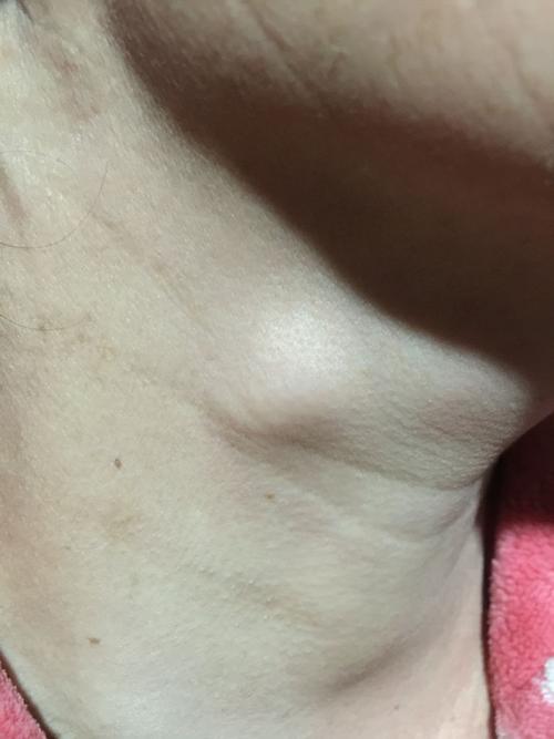 喉咙的位置长了个小包,不痛不痒,用手按会动.怎么回事