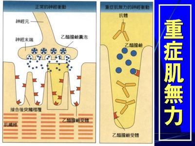重症肌无力患者的心理护理方法有哪些