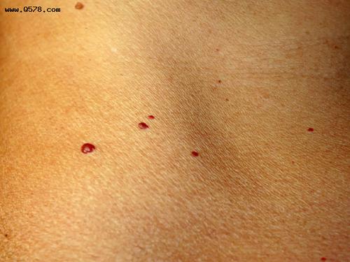 成人血管瘤的治疗方法是什么?如何预防?