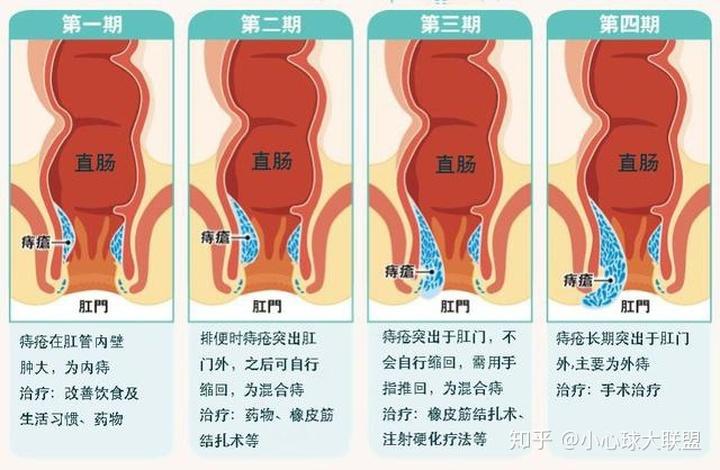 久坐,久蹲,尽量缩短排便时间; 抬举重物时尽量避免长时间屏气; 痔疮
