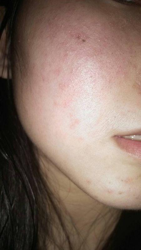 是激素依赖性皮炎还是脂溢性皮炎?