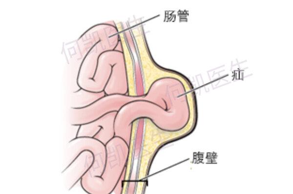 腹部手术有28%的患者会发生不同程度的切口疝.