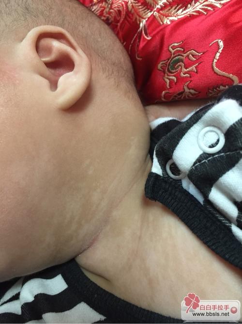 李博士你好,帮忙看看宝宝是无色素痣还是汗斑?