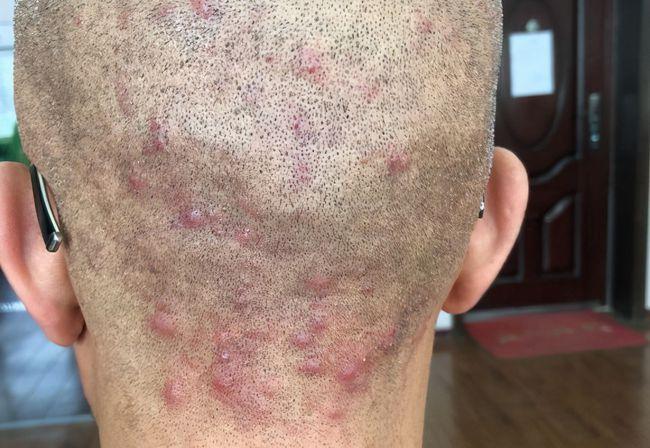 毛囊炎!|丘疹|头皮屑|细菌