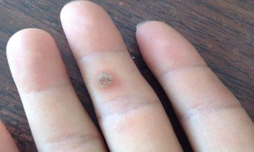 瘊子好发于儿童及青少年,多见于手背,手指及足缘等处,因此儿童手上