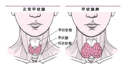 甲状腺肿大的病因是什么