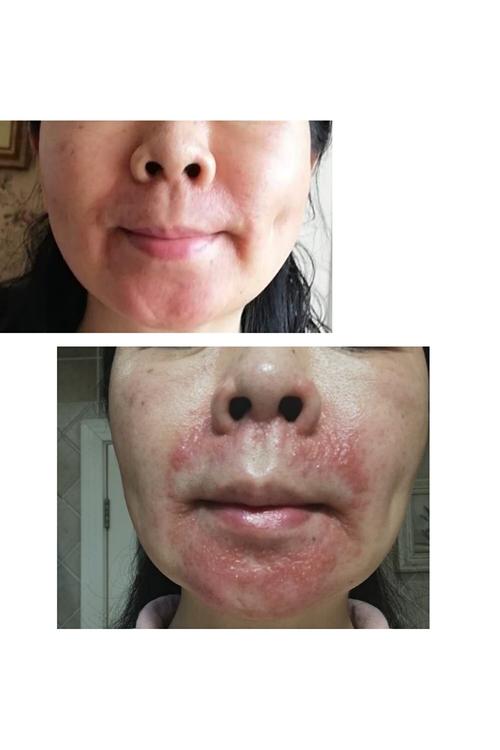 激素依赖性皮炎找对医生,疗效佳!
