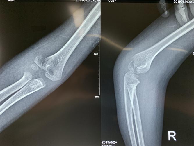 小儿胳膊骨折(肱骨外髁骨折)