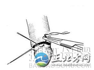 医学图解:包皮手术全过程 组图
