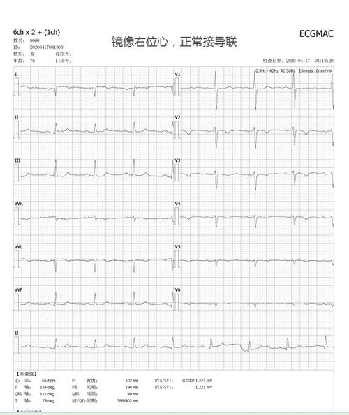 镜像右位心,正接导联