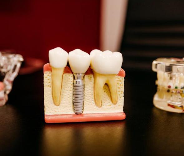 牙周病患者做种植牙失败率很高种牙前要注意这方面