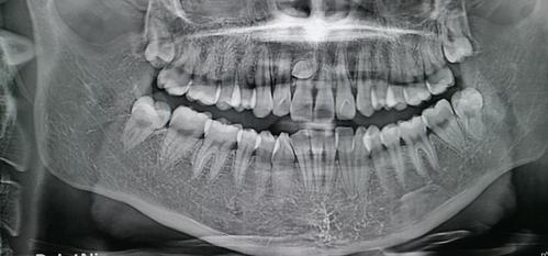 终于去拔了多生牙/埋伏牙/阻生牙(上颚多生牙)!