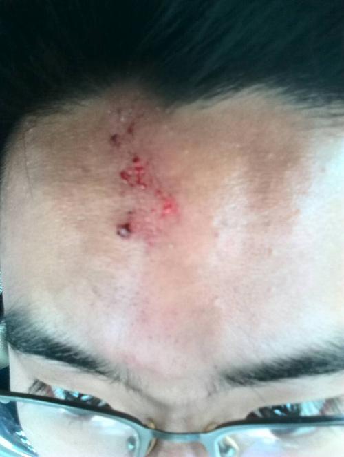 撞得很重,但是没什么不良反应,鸡蛋大小,伤口也破皮了,但是出血很轻