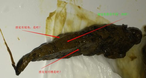 肠癌大便图片大全