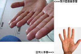 手心出汗