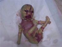 鳄皮婴儿综合征