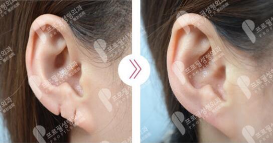 普罗菲耳整形医院各类耳垂整形方法