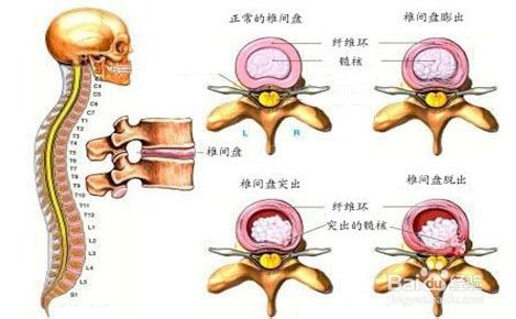 颈,腰椎间盘突出的诱因及预防措施