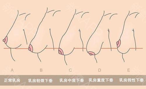 乳房下垂的原因其实只有3种