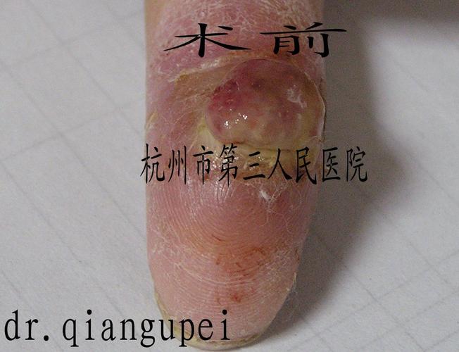 化脓性肉芽肿怎么治疗(皮肤病系列3)